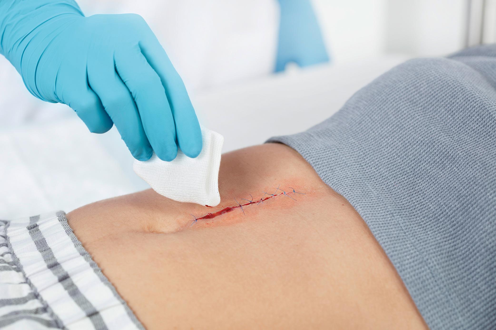 Leukoplast compress cotton gauze unsteril PK 100 10,0 x 10,0cm 8fach